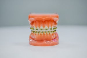 Closing gaps with Invisalign treatment
